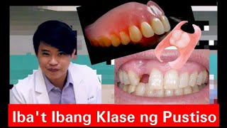 Ibat Ibang Klase ng PUSTISO Metal Flexible Stayplate Complete Denture 20 [upl. by Sherborn]