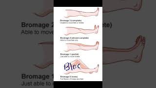 Bromage Score  Anesthesia painmanagement shoreyoutube viral video medical [upl. by Nuahc]