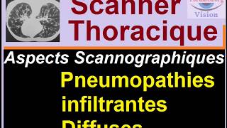 interprétation de Scanner et radiographie Thoracique Diagnostic des Pneumopathies et fibroses [upl. by Hess]