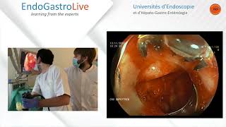 Hemostase endoscopique dun ulcère duodénal hémorragique [upl. by Atinav]