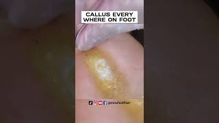 CALLUS EVERYWHERE ON FOOT 2023  NEVER ENDING CALLUS SCRAPING  BY FOOT SPECIALIST MISS FOOT FIXER [upl. by Naaman651]