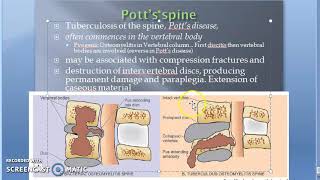 Pathology 825 h TB Spondylitis Tuberculous Osteomyelitis Potts Spine Disease disc body bone [upl. by Llertnad570]