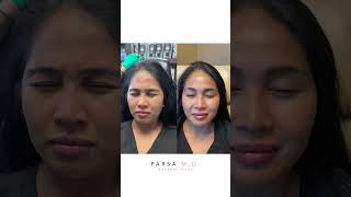 Xeomin Results for Crows Feet 11 Lines and Forehead  Dr Kami Parsa [upl. by Alimat]