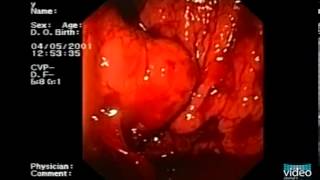 Endotherapy of Gastric Fundal Varices IntraVariceal Injection of NButyl2Cyanoacrylate [upl. by Chariot536]