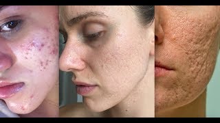 Types Of Acne Scars [upl. by Lerraf]