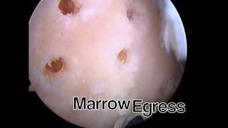 Arthroscopic MicroFracture Trochlear Groove by Chad Smalley MD [upl. by Clough]