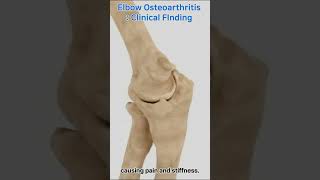 Discover The Root Of Elbow Pain Osteoarthritis Uncovered [upl. by Noirb]