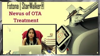 Nevus of OTA Treatment in Delhi India  Tvak Laser Clinic  Dr Jaishree  Dermatologist in Delhi [upl. by Verine]