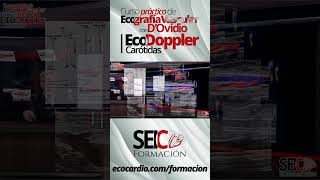 Curso Práctico de Ecografía Vascular  Eco Doppler Carótidas [upl. by Niamjneb153]