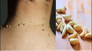 Remove Skin Tags  Home Remedies To Remove Skin Tags Easily [upl. by Ullyot]