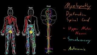 Syndrome Myelopathy [upl. by Ycat]