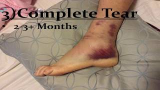 Sprained Ankle Ligaments Best Home Treatment [upl. by Alrrats266]