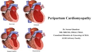 Peripartum Cardiomyopathy  MRCOG Part 2 amp 3 Task [upl. by Gnni]