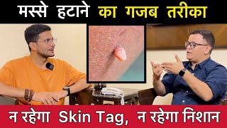 Skin Tags या मस्से हटाने का तरीका  Skin tags removal without surgery  Homeopathy  Himanshu Bhatt [upl. by Lokim]