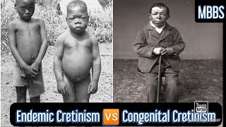 Endemic Cretinism 🆚 Congenital Cretinism  MBBS NEXT NEETPG [upl. by Olegnad]