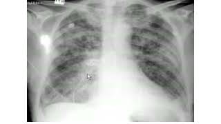 Pulmonary edema XRay review [upl. by Vola]