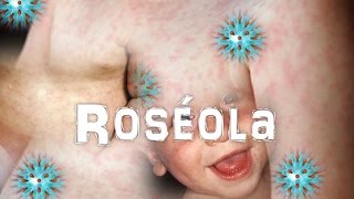 Virus Herpes Humano 6 Y 7Roseola [upl. by Kath]