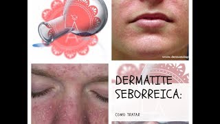 Dermatite Seborreica Facial Como Tratar [upl. by Geer]