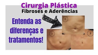 Fibroses e Aderências pós lipo abdominoplastia o que são e como melhorar [upl. by Gradey]