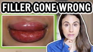 FILLER GONE WRONG 😮 TOP 5 FILLER COMPLICATIONS 💉DERMATOLOGIST DrDrayzday [upl. by Eyt]