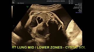 Ultrasound target scan  Abnormal lungs sonography [upl. by Rosalia]