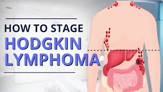 Hodgkin Lymphoma Staging From Diagnosis to Prognosis  The Patient Story [upl. by Llenrahs]