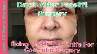 5 Days After Facelift Surgery 8 [upl. by Ralat]