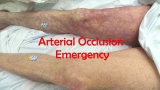 Acute Complete Occlusion of the Leg Arteries [upl. by Inacana660]