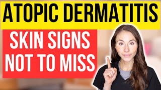 Dont Miss These 15 Signs Of Atopic Dermatitis [upl. by Atival123]