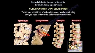 Spondylolysis Spondylolisthesis Spondylitis SpondylosisEverything Need To KnowDr Nabil Ebraheim [upl. by Ogirdor]