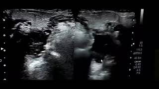 Inside sonography easy approach to rollout Inflamed Tonsils on ultrasound Do Watch and subscribe [upl. by Upali]