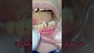 أسباب فقدان الاسنانCauses of tooth lossdrabdullahsultandentist dentist shorts shortvideo [upl. by Korten]