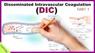 DIC Disseminated Intravascular Coagulation  Part 1 [upl. by Kipton]