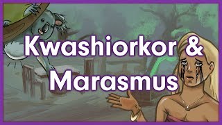 Kwashiorkor vs Marasmus  Nutrition Mnemonic [upl. by Nettle962]