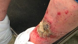 Staph Infection or Abscess What is it [upl. by Acinorej]