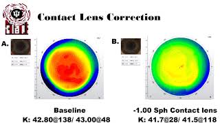 Anisometropia and Aniseikonia Treatment [upl. by Nichol]