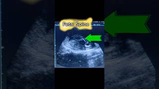 How to Obs Ultrasound Pregnancy Scan shorts [upl. by Hecker643]