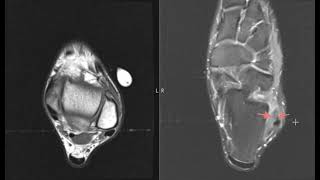 Pain and swelling in lateral ankle from anterior talofibular ligament sprain [upl. by Epner]