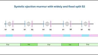 Systolic ejection murmur with fixed split S2 [upl. by Wadell]