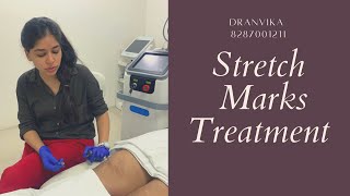 3 Best Stretch marks treatment🤩  Laser for stretch marks [upl. by Aihsiek440]