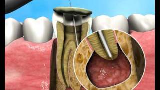 Treatment of Apical Periodontitis  a new approach [upl. by Kaia]