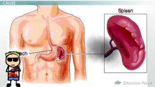 Hereditary Spherocytosis [upl. by Adianes]