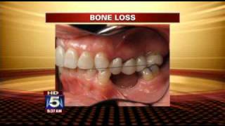 Coping with Tooth Loss [upl. by Tonnie755]