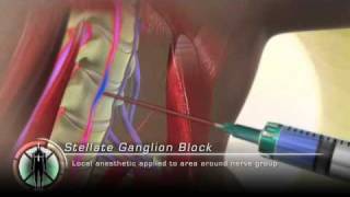 Stellate Ganglion Block Injection [upl. by Deane591]