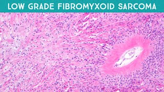 Low grade fibromyxoid sarcoma LGFMS Evans tumor explained in 5 minutes pathology [upl. by Odlanir]