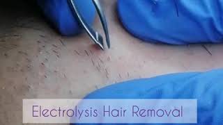 Electrolysis Permanent Hair Removal Face [upl. by Sivaj]