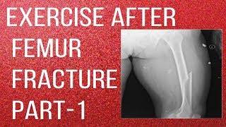 Exercise After Femur Fracture Part1 Thigh Bone Fracture Rehabilitation [upl. by Muryh75]