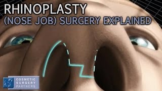 Rhinoplasty Nose Job explained  Cosmetic Surgery video animation [upl. by Krystle]