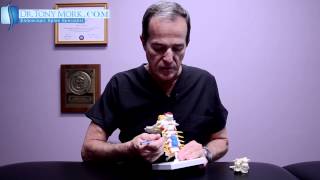 Cervical Foraminal Stenosis After Fusion by Dr Tony Mork [upl. by Michaud]