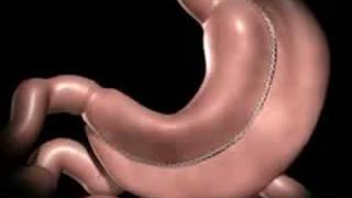 Laparoscopic Vertical Sleeve Gastrectomy by Marc Zare MD [upl. by Farmelo383]